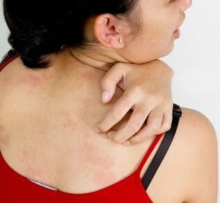 Κοκκιώματα στο σώμα - συμπτώματα παρουσίας παρασίτων