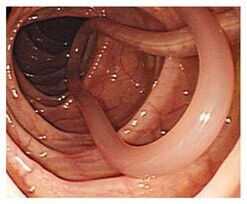 Παράσιτα στο ανθρώπινο σώμα