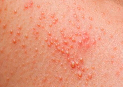 Όταν το σώμα μολύνεται από παράσιτα, εμφανίζεται μια δερματική αλλεργία